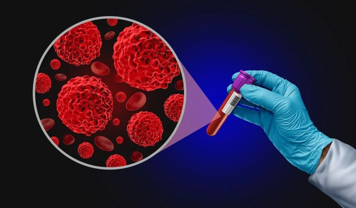 Rolul biopsiei lichide in diagnosticarea cancerului: interpretarea rezultatelor si valori normale
