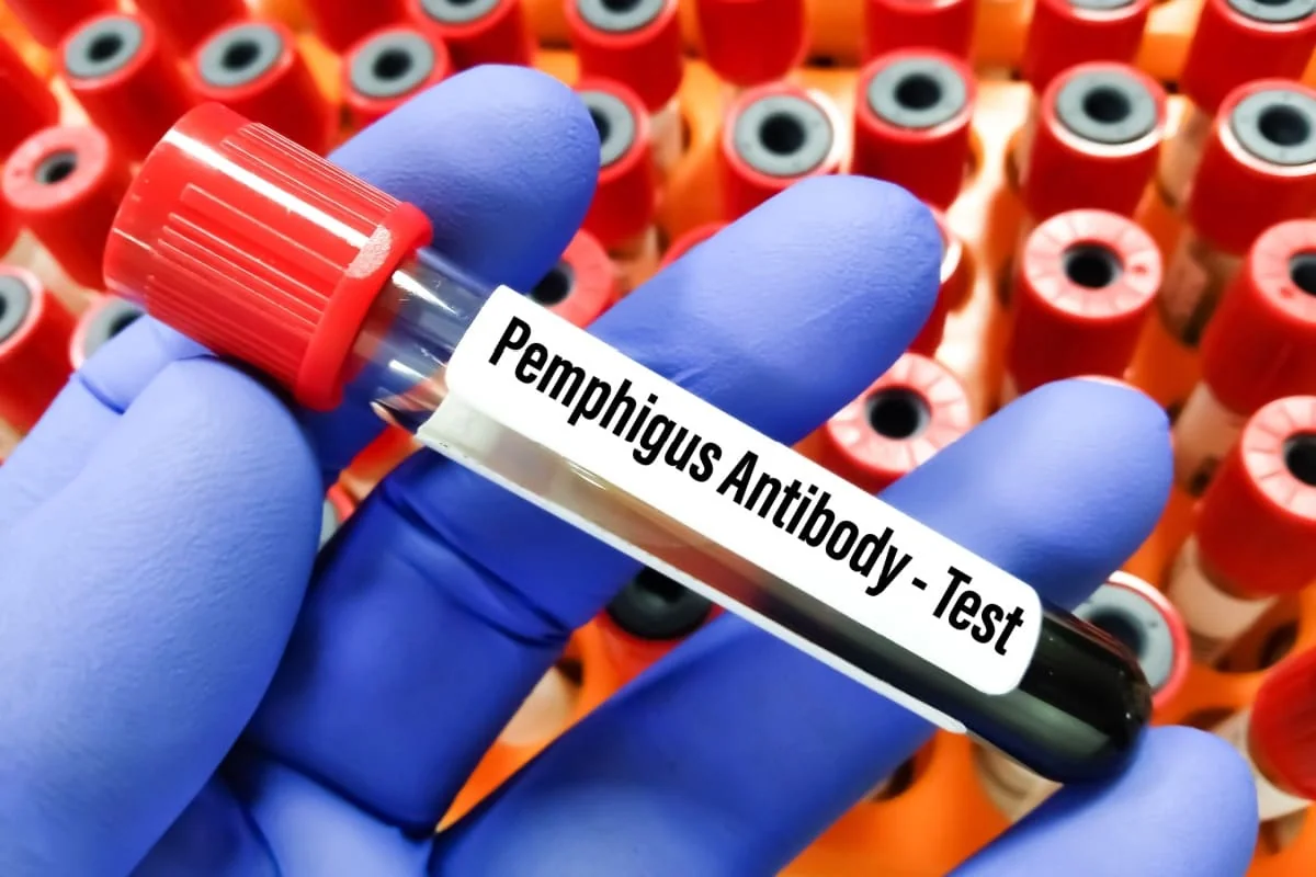 Pemfigus vulgar: cauze, simptome, tratament
