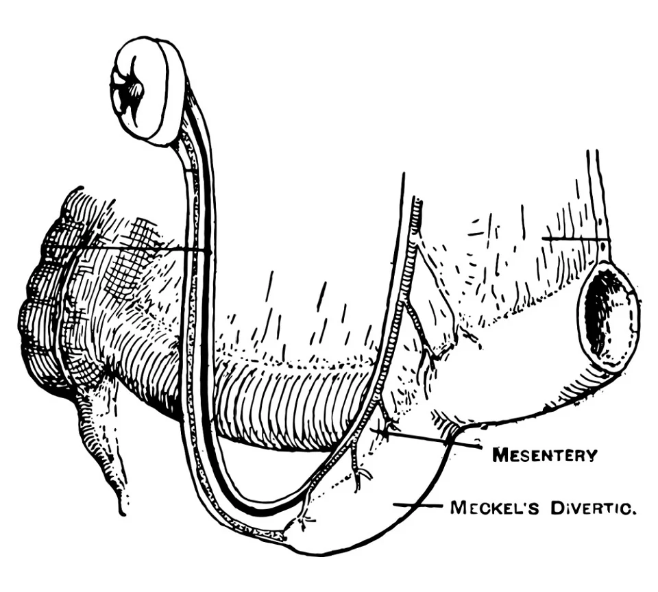 Diagnosticarea diverticulului Meckel