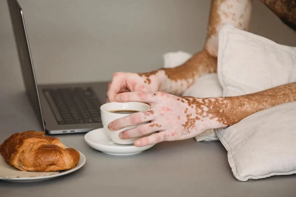 Cauze si factori de risc pentru vitiligo Cauze si factori de risc pentru vitiligo