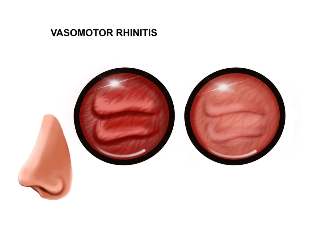 Vasomotor rhinitis
