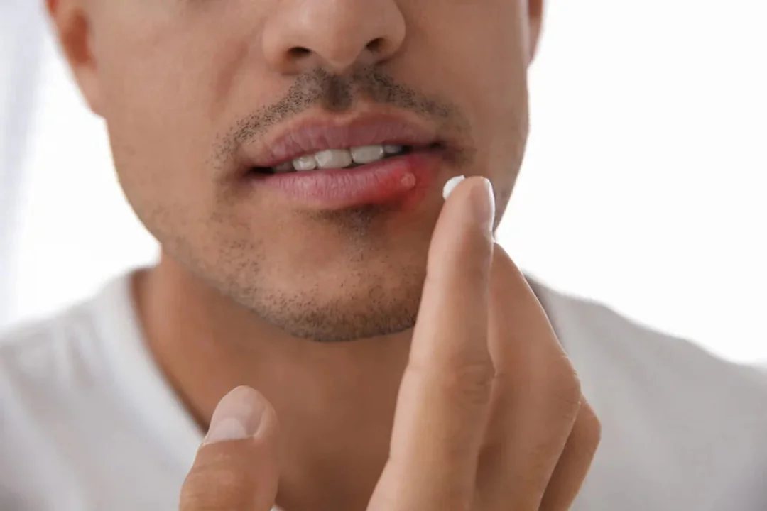 barbat cu Herpes oral barbat cu Herpes oral