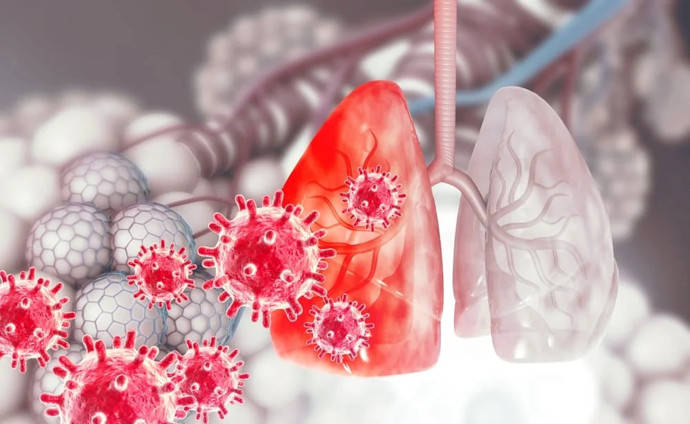 Virus sincitial respirator: ce este si ce trebuie sa stii despre el