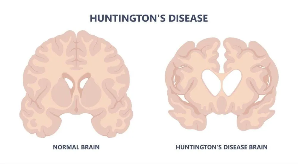 diferenta dintre creier normal si cel cu boala huntington