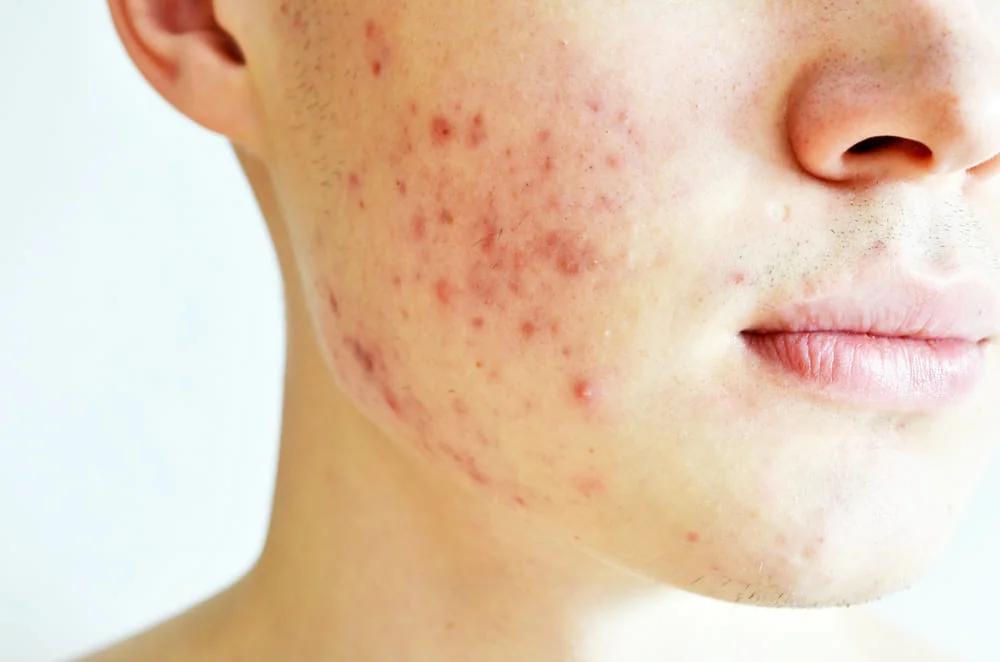 Baiat cu sebum