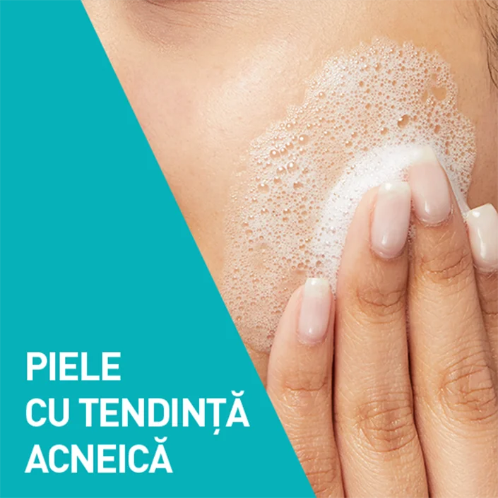 Piele cu tendinta acneica Piele cu tendinta acneica
