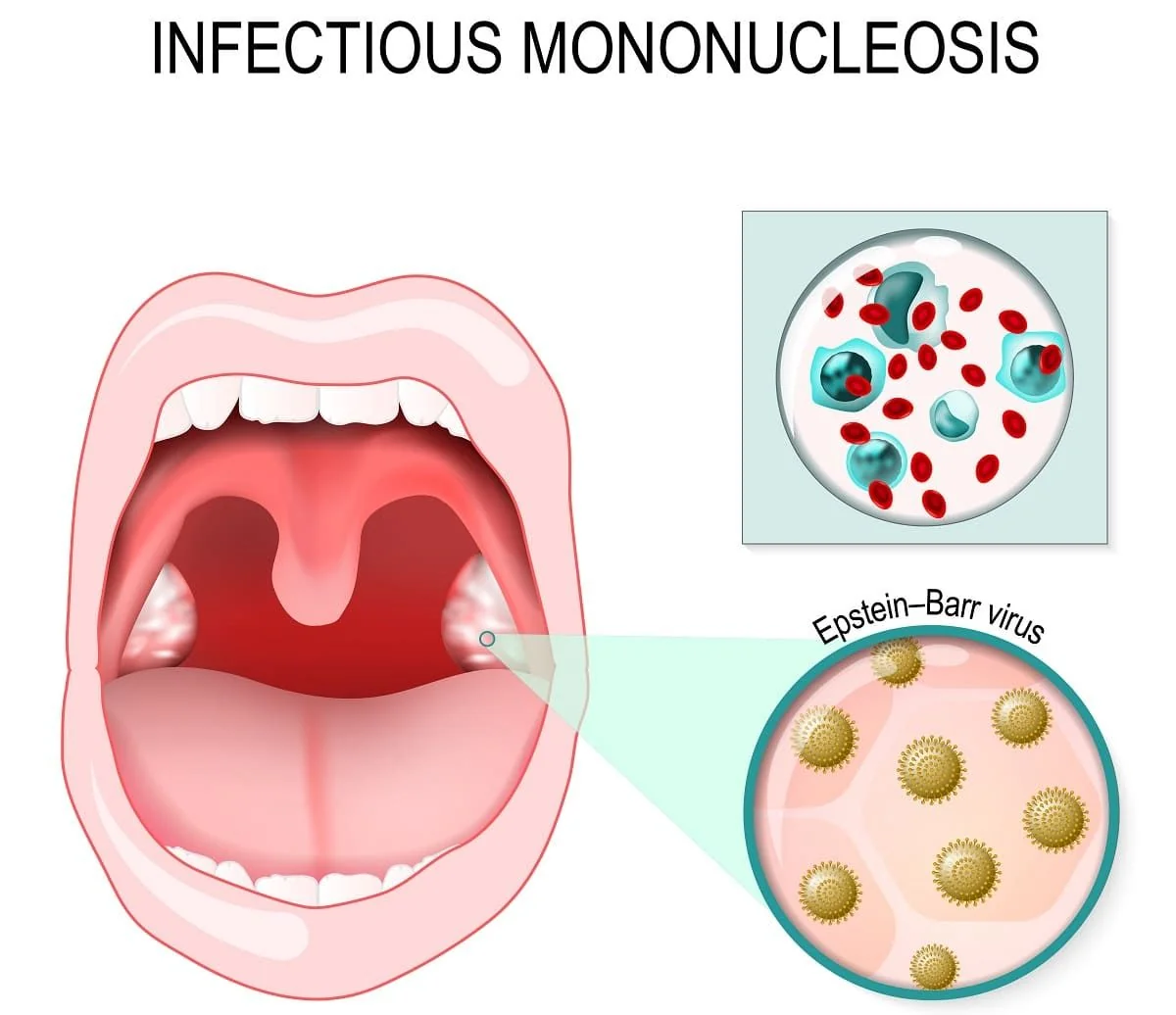 Mononucleoza (boala sarutului): simptome, cauze si tratament