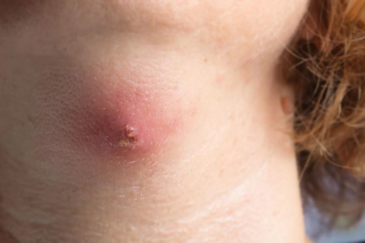 Actinomicoza: cauze, simptome, tratament