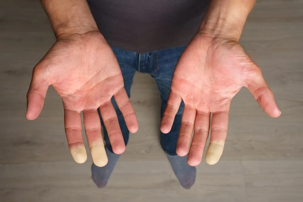 maini cu degete decolorate