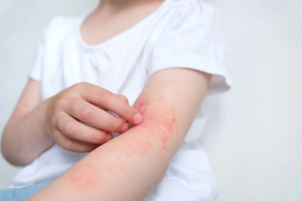 Dermatita (Dermita): cauze, simptome, tratament