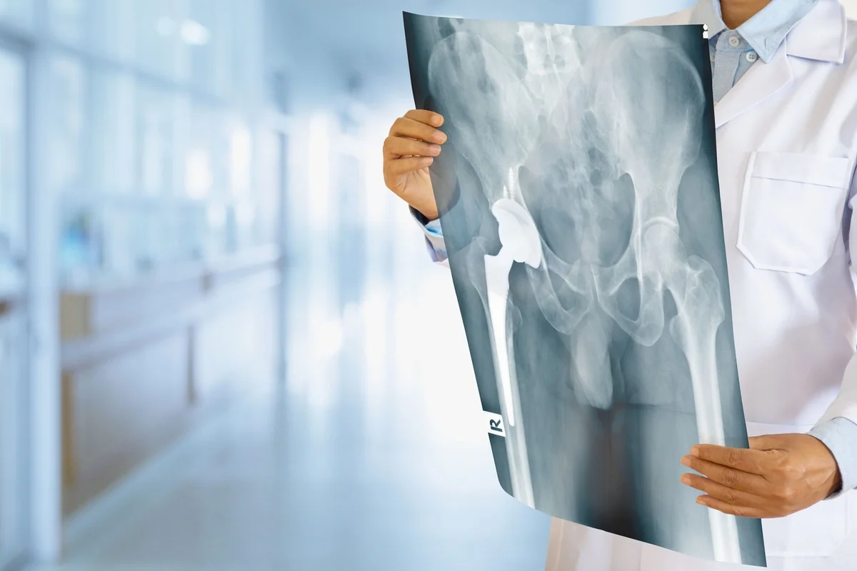 radiografie osul femural radiografie osul femural