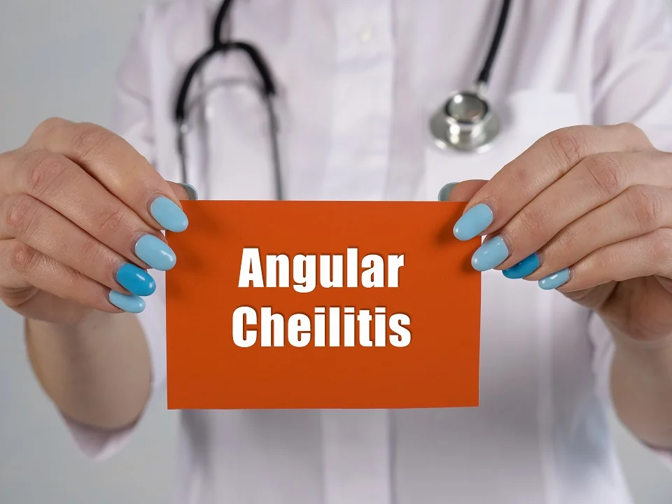 Angular Cheilitis Angular Cheilitis