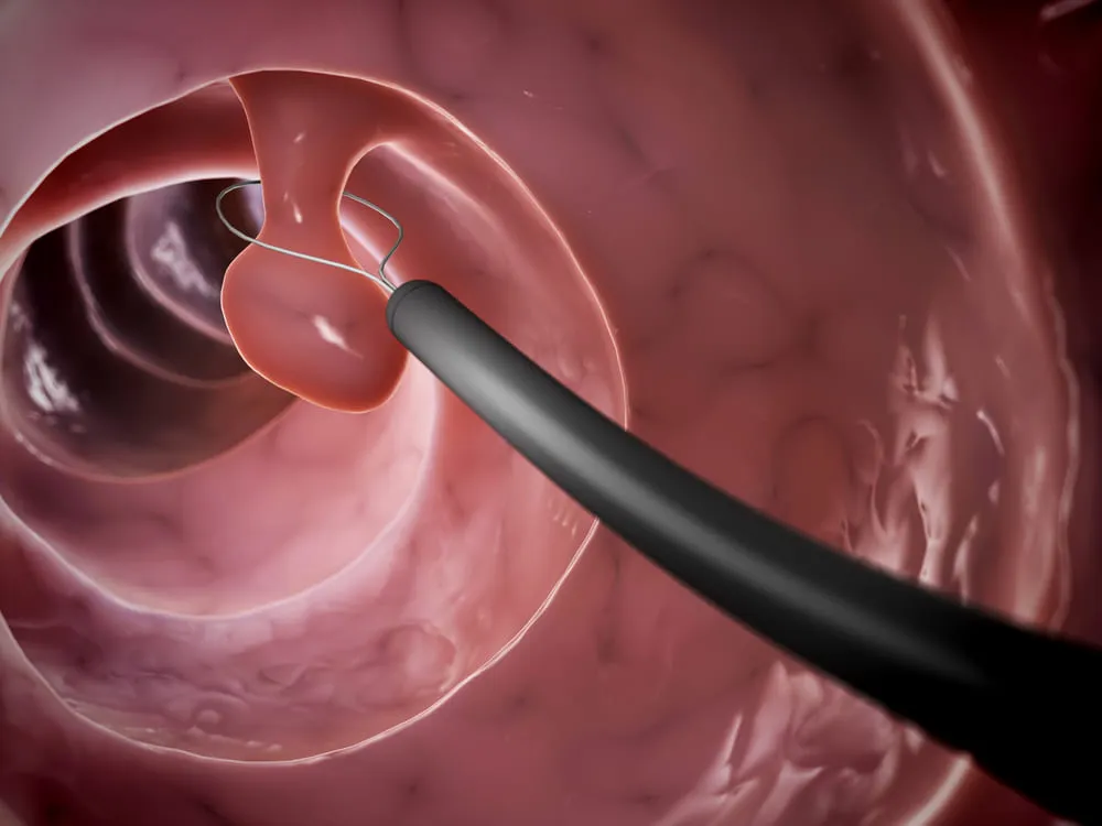 Disectia endoscopica a polipului de colon
