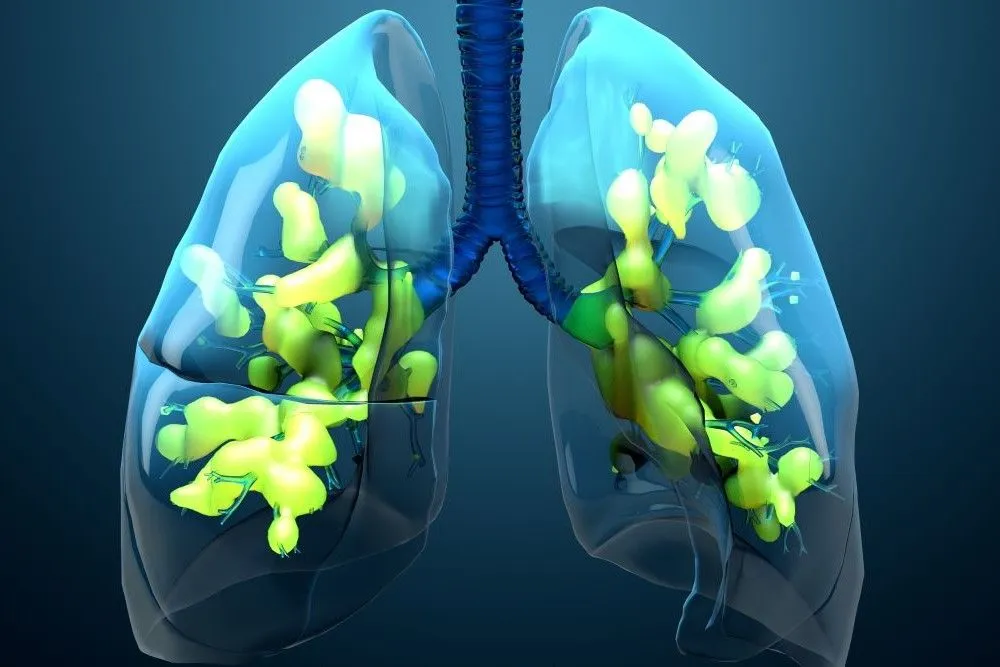 Detresa respiratorie (SDRA): cauze, simptome, tratament