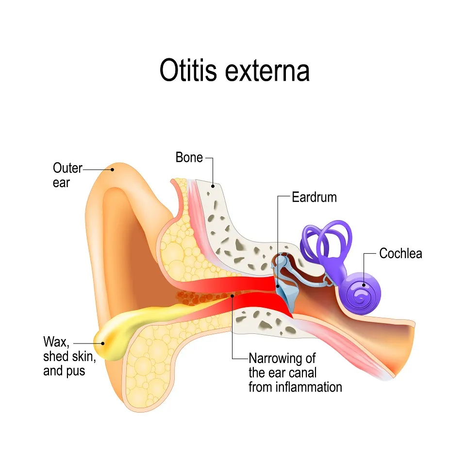 inflamatia urechi, otita