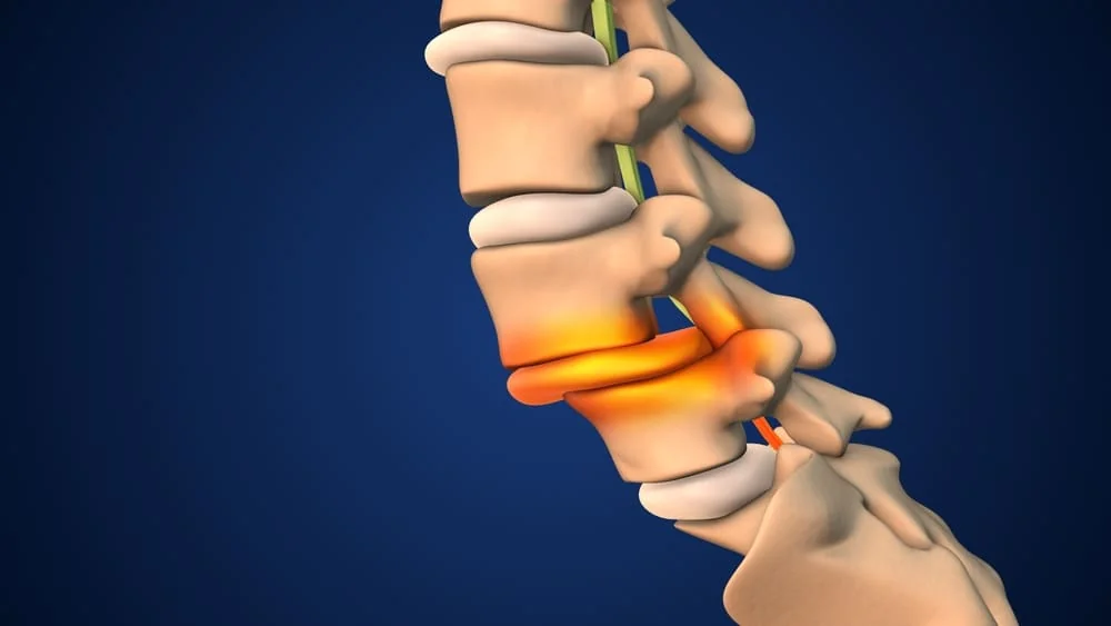 Spondilolistezis: cauze, simptome, tratament