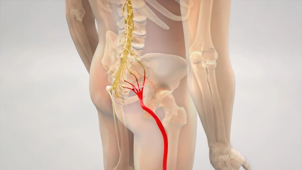 Lombosciatica: cauze, simptome, tratament