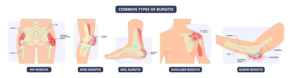 Tipuri de bursita Tipuri de bursita