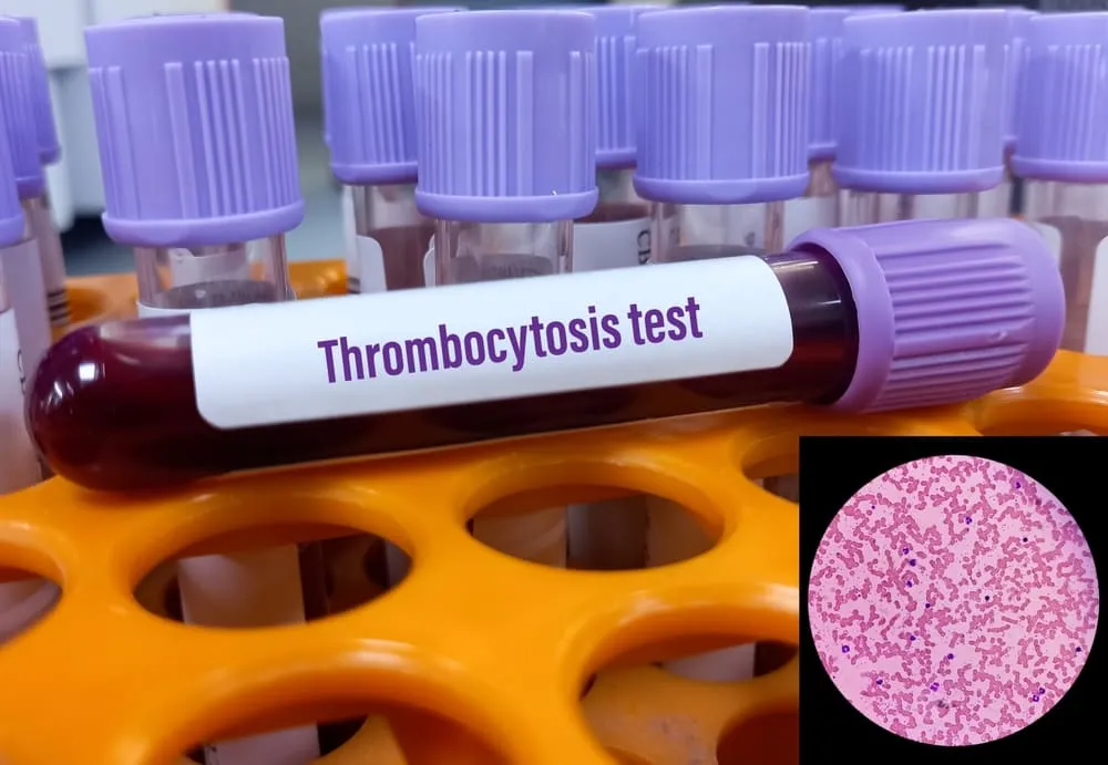 Test Trombocitoza