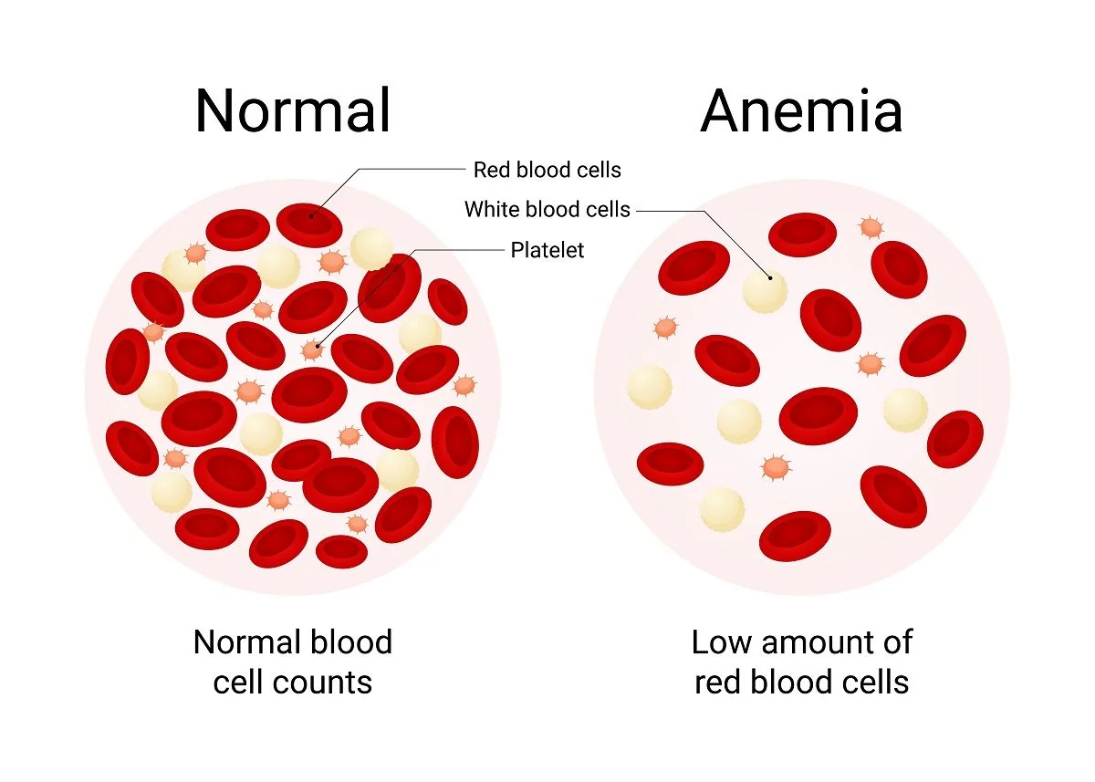 Anemia (scaderea hemoglobinei): Cauze, simptome, diagnostic si tratament