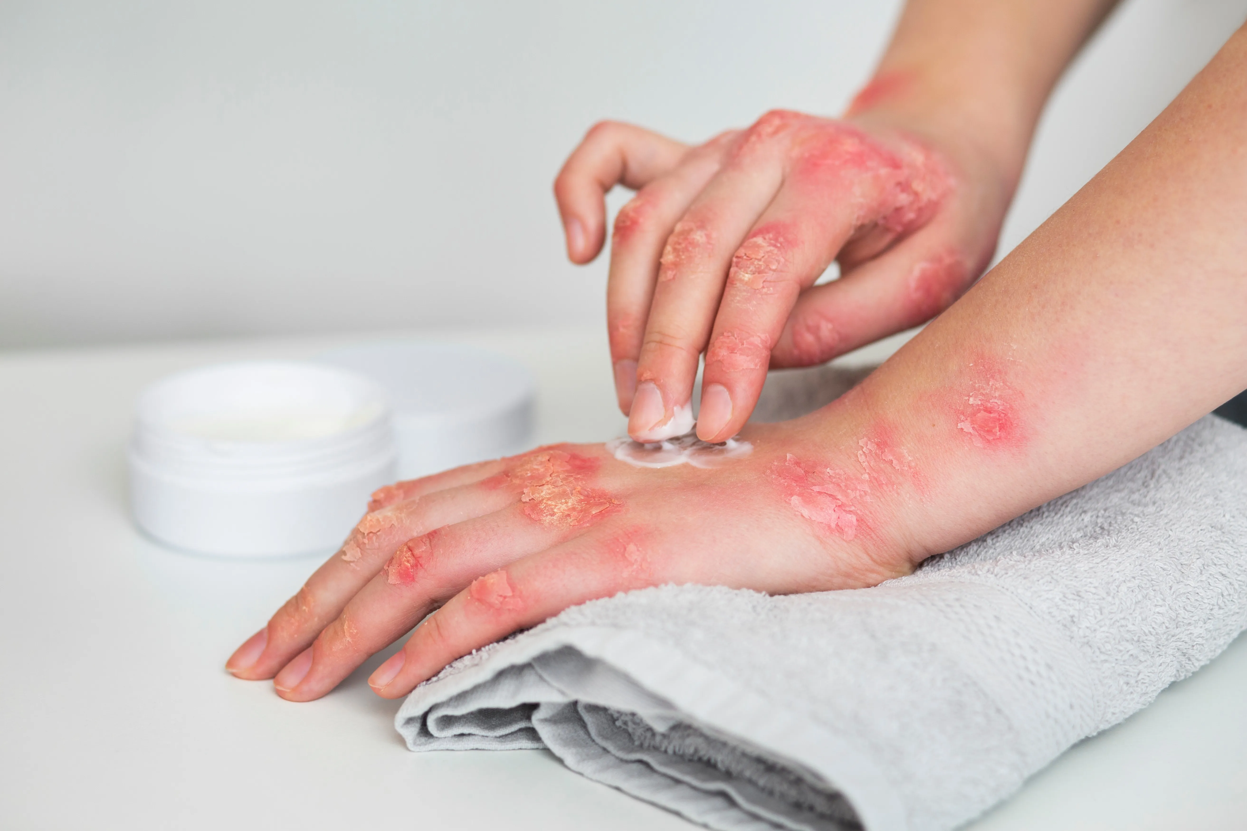 Dr. Cristina Nisipasu, medic primar dermato-venerologie: despre eczeme si cum le putem trata?