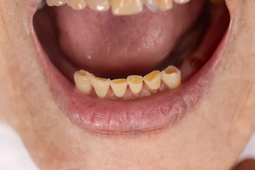 Eroziune dentara (odontoliza): cauze, simptome, tratament