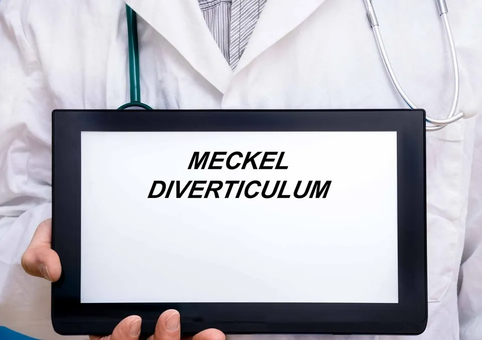 Diverticul Meckel