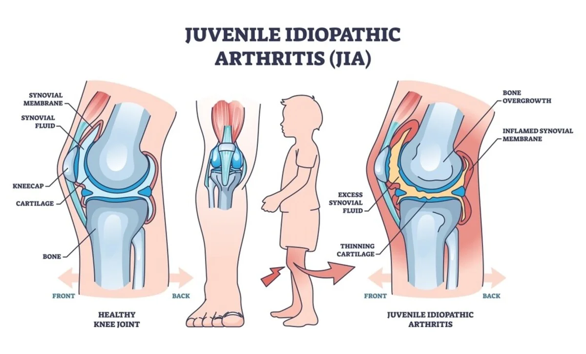 Artrita juvenila idiopatica – simptome, cauze, diagnostic si tratament