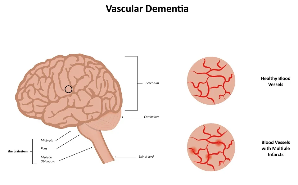 Vascular Dementia Vascular Dementia