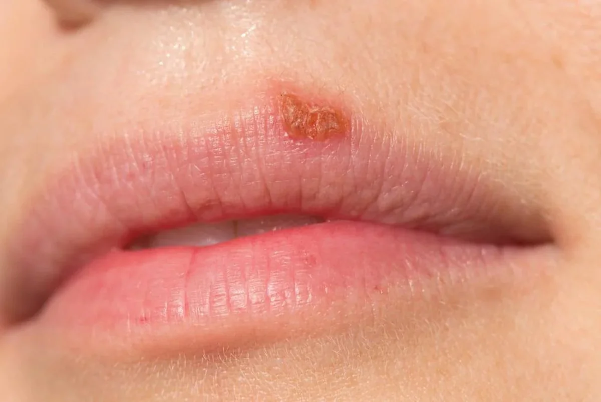 Herpes oral (buze) – simptome, cauze si tratament