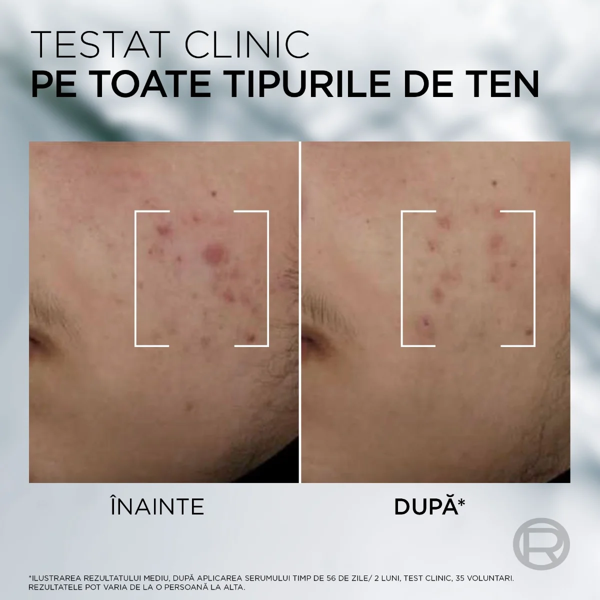 Ser anti imperfectiuni cu 3% acid salicilic si niacinamida, 30ml, L'oreal Men Expert