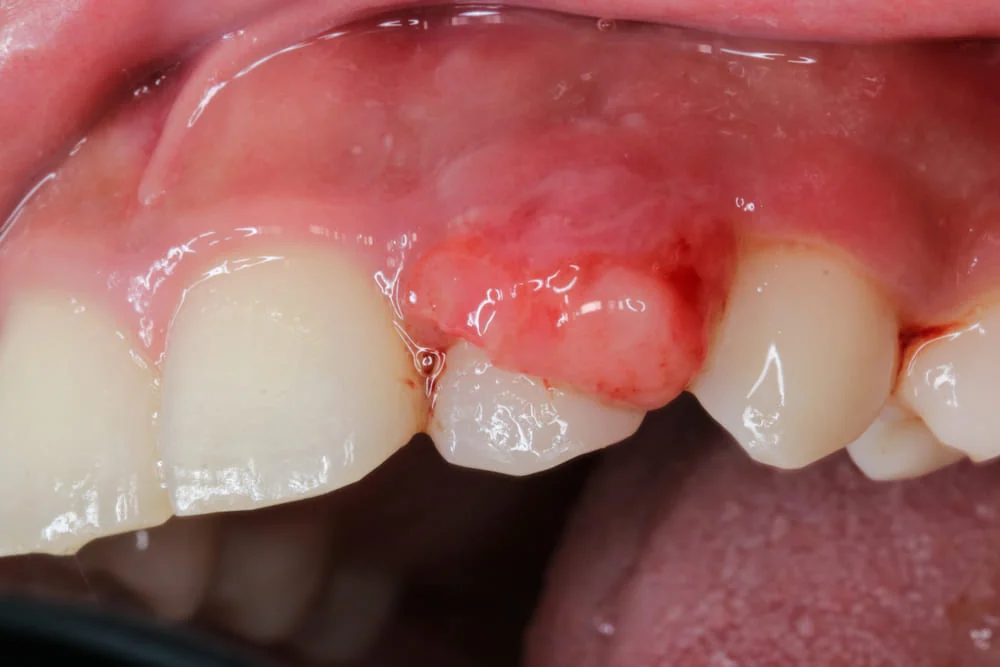 Granulom dentar: cauze, simptome, tratament