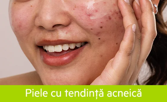 Piele cu tendinta acneica Piele cu tendinta acneica