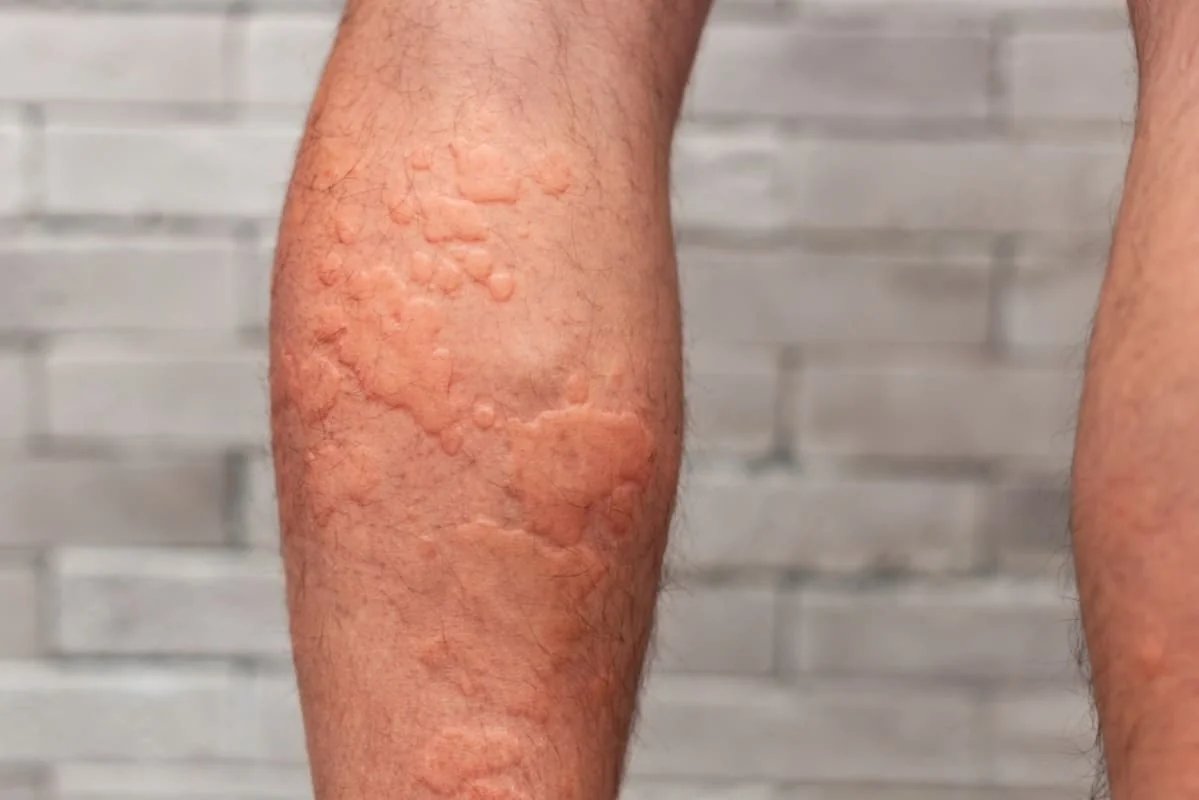 Vasculita nodulara (boala Bazin): cauze, diagnostic si optiuni de tratament