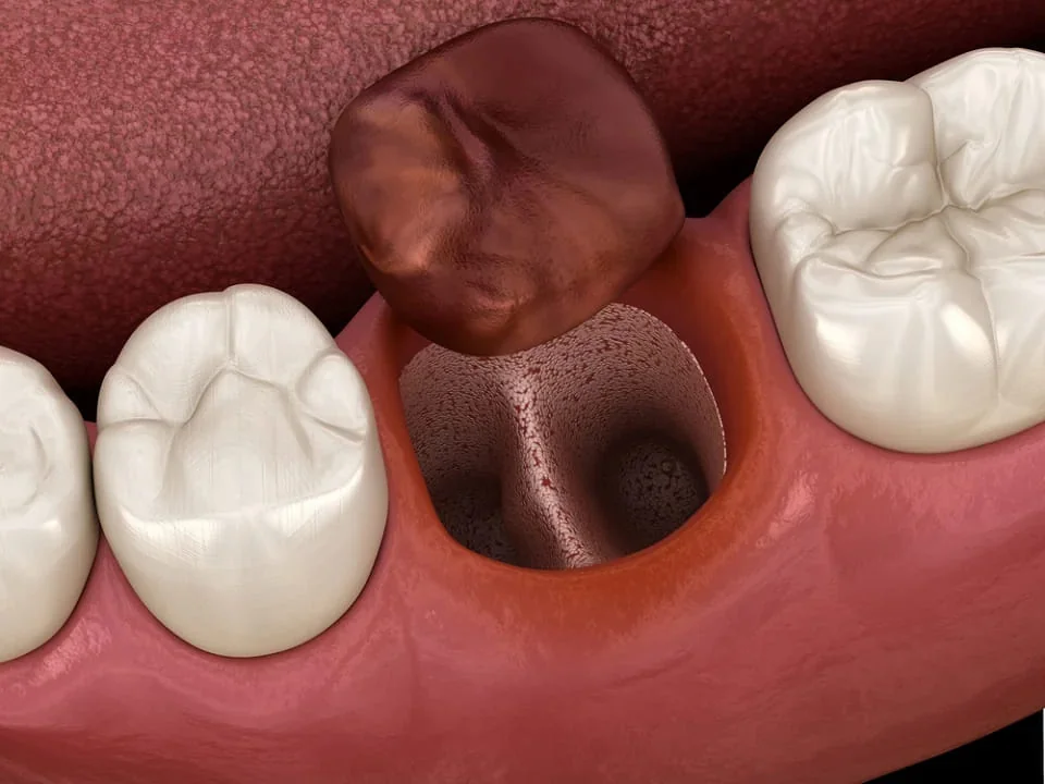 Cauzele aparitiei alveolitei Cauzele aparitiei alveolitei
