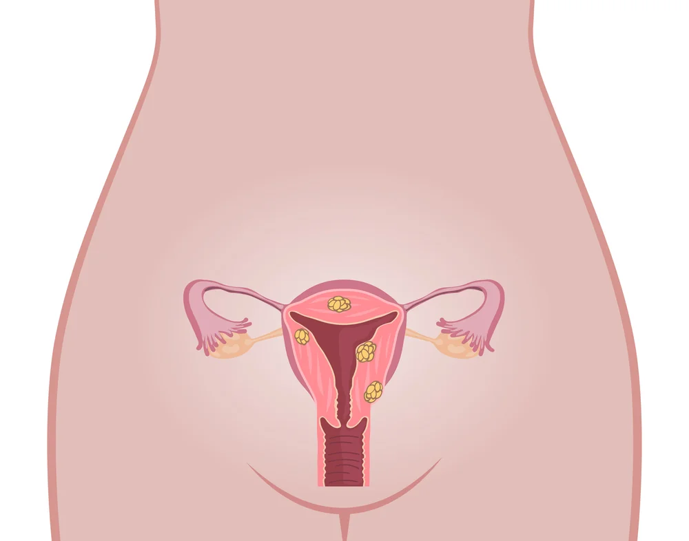 Uter fibromatos: cauze, simptome, tratament