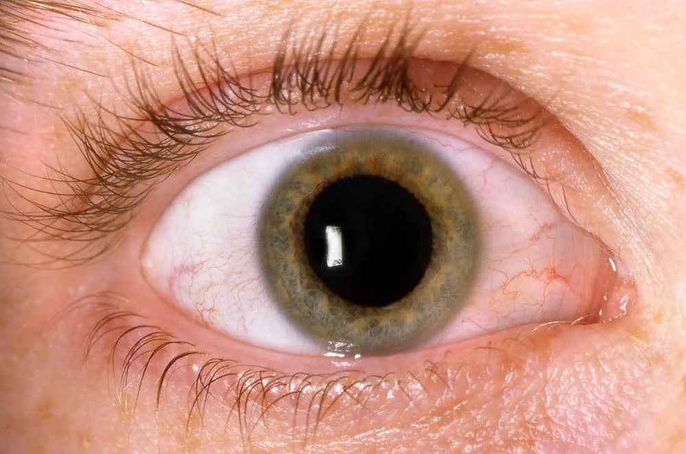 Retinopatia diabetica: cauze, simptome, optiuni de tratament