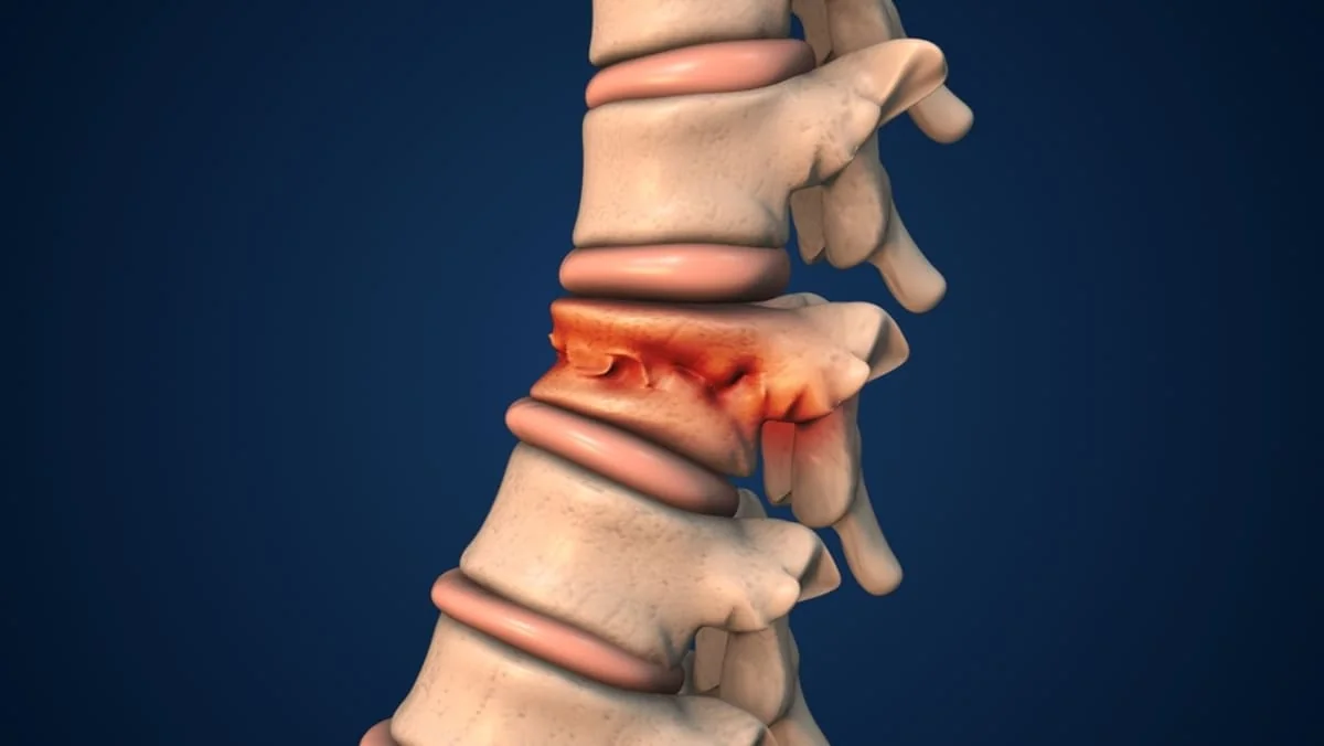 Fractura de coloana: tipuri, cauze, simptome, tratament
