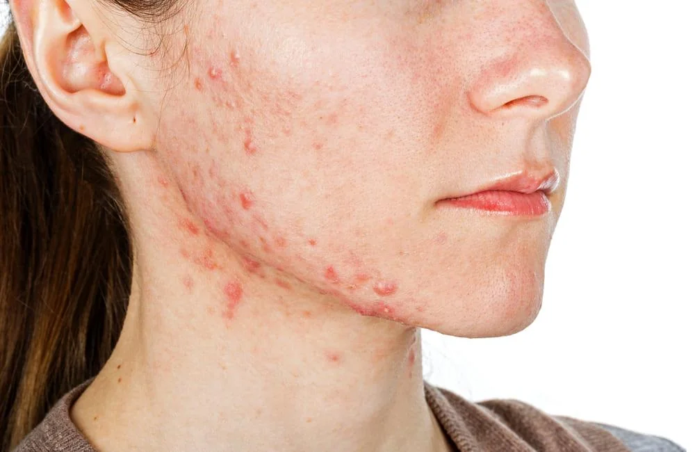 Acneea hormonala: cauze, manifestari si optiuni de tratament