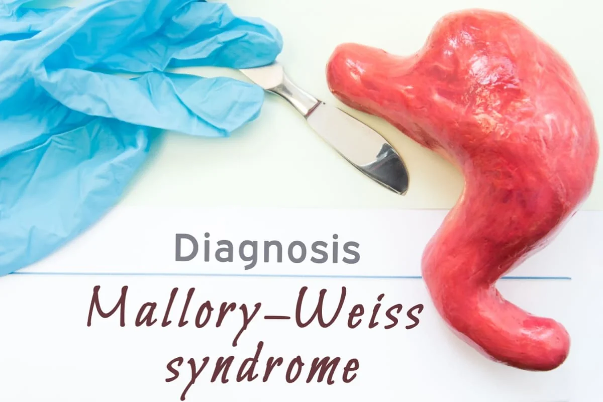 Sindromul Mallory Weiss: cauze, simptome, tratament