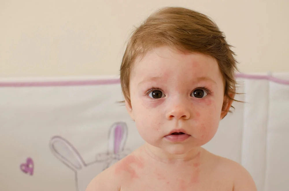 Bebe cu roseola infantum Bebe cu roseola infantum