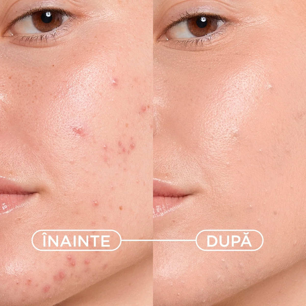 Gel crema nuantatoare anti-imperfectiuni Sebium Kerato+ Cover, 30 ml, Bioderma