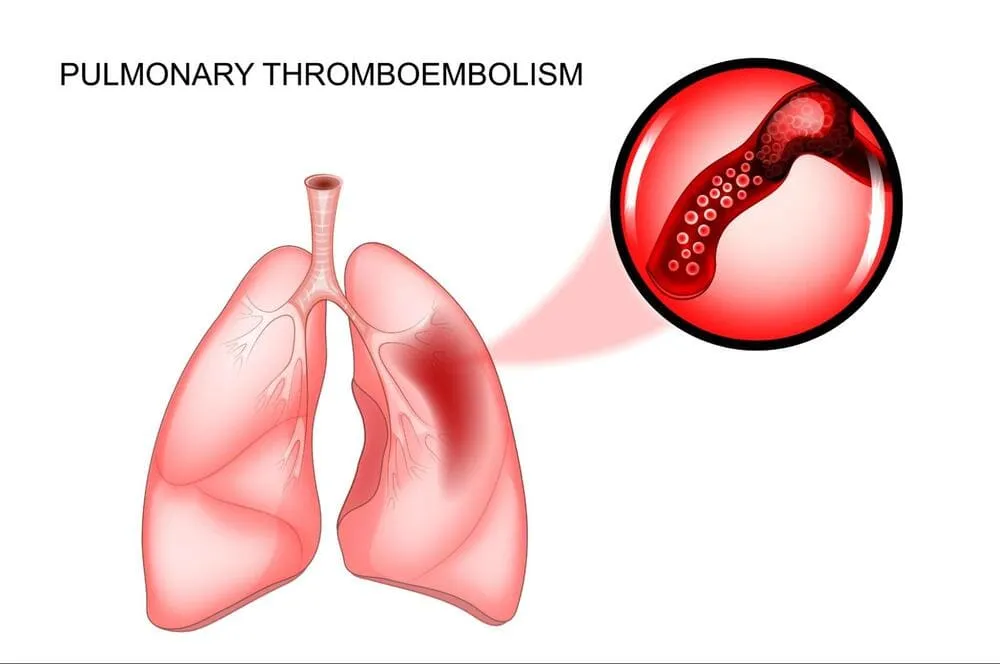 Tromboembolismul  pulmonar