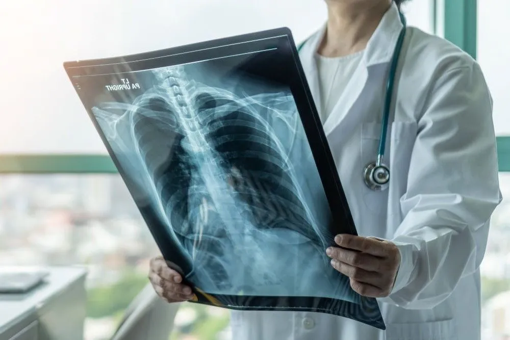 Radiografie pulmonara: ce este si cand se recomanda