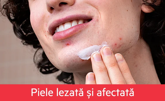 Piele lezata si afectata Piele lezata si afectata
