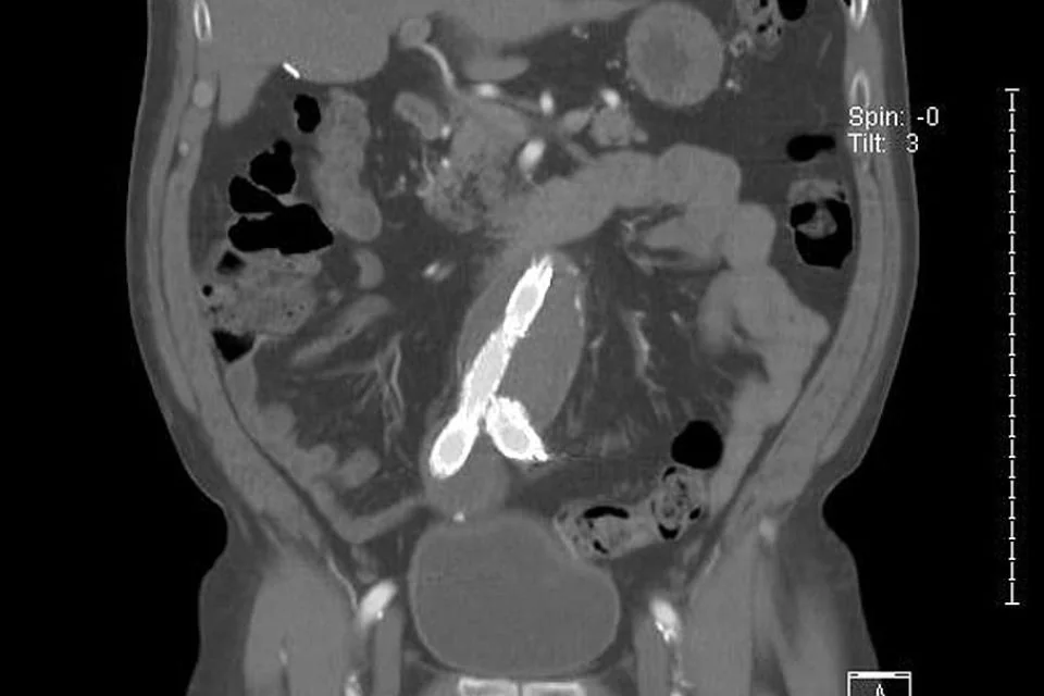 ecografie anevrism aortic ecografie anevrism aortic
