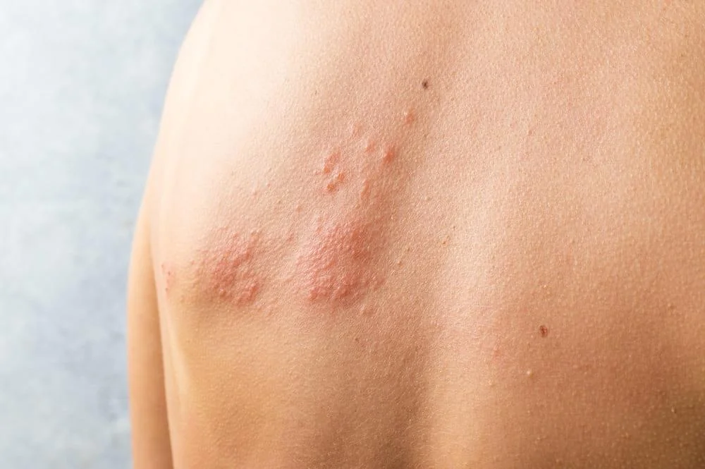 Urticarie: ce este, cauze, simptome, tratament