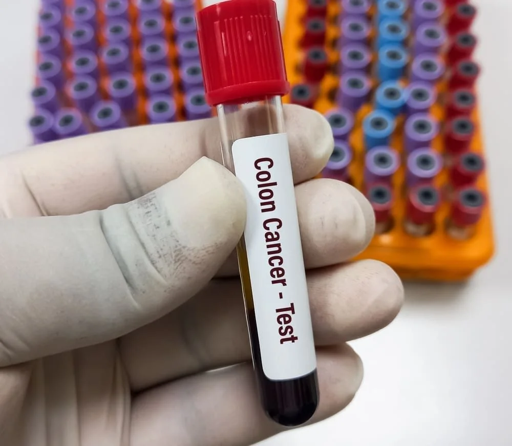 Test cancer colon: in ce consta si cand se recomanda