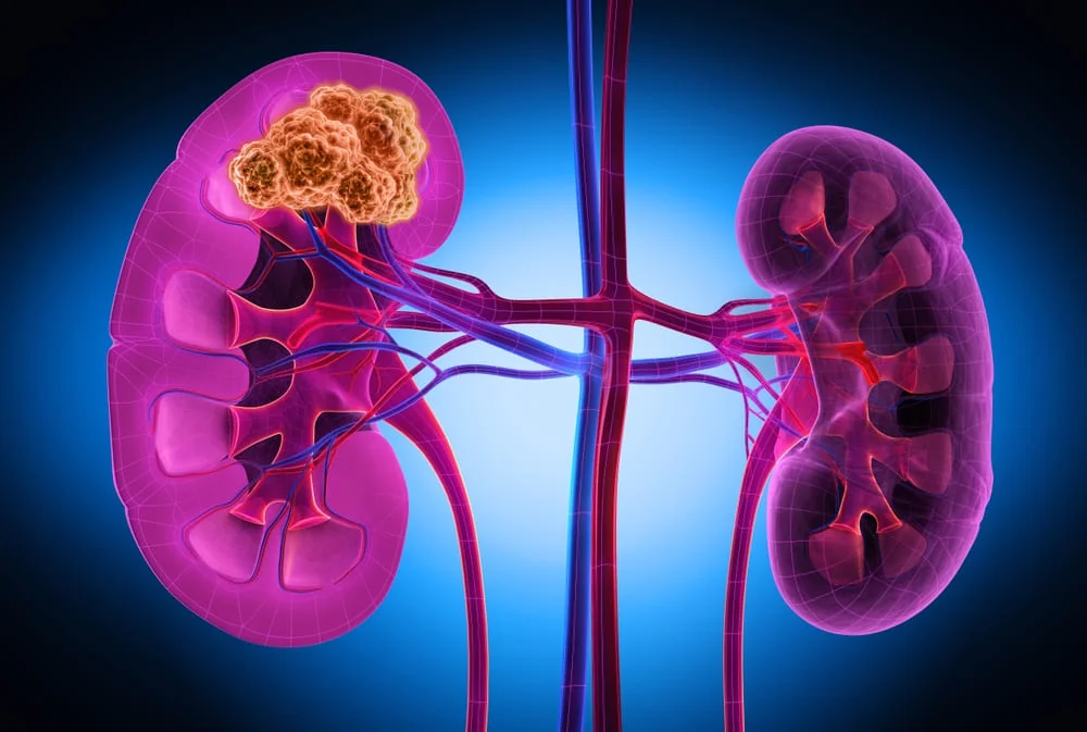 Oncocitom: cauze, simptome, tratament