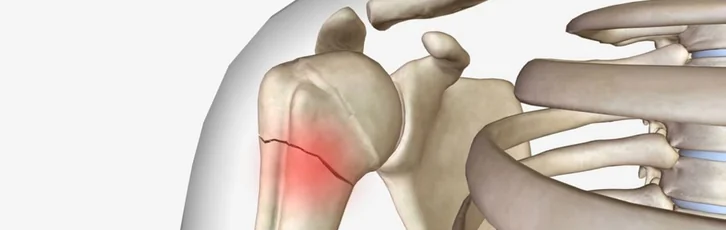 Fractura de humerus: cauze, simptome, tratament